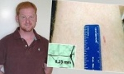 Image: Dr Bradley Launikonis and a thigh biopsy.