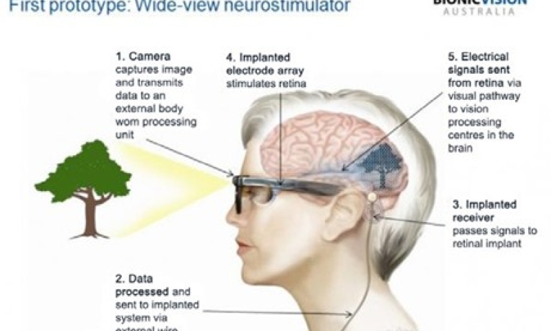diagram of the bionic eye.